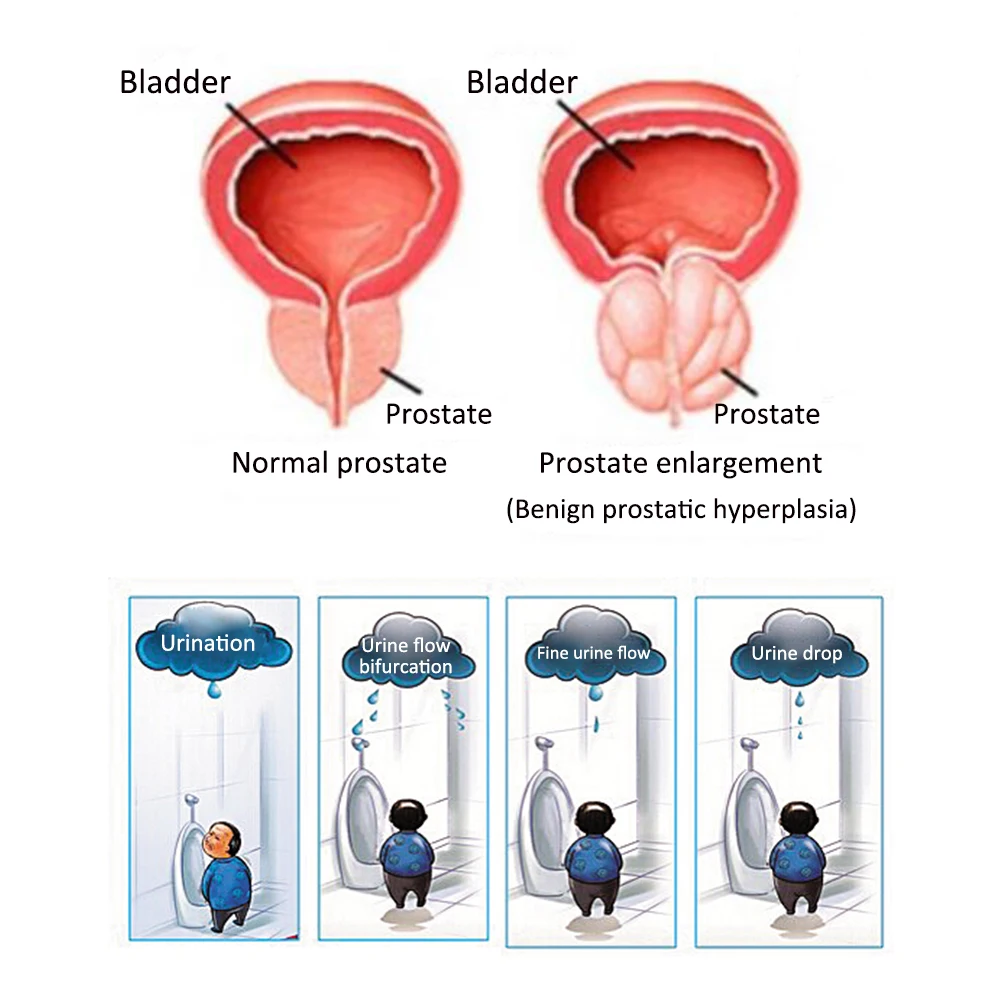 prostata cronica cura