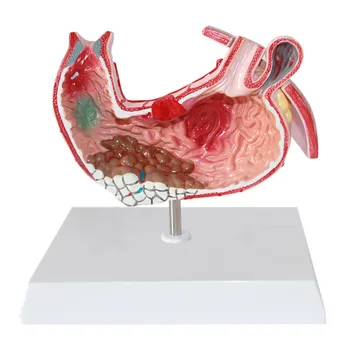 Boli Gastrice Demonstrație Stomac Patologice Model De Anatomie Consumabile Medicale