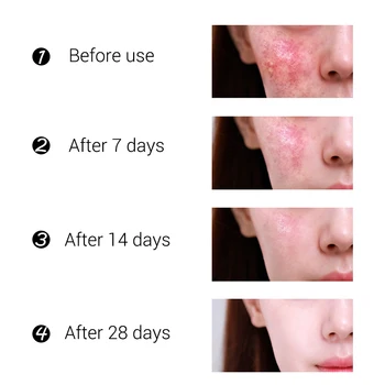 BREYLEE Anti Acnee Crema Acnee Cicatrice Remover Gel Facial Crema Tratament pentru Acnee Cos Îndepărtarea Ser cu Ulei de Control Psihiatru Porilor de Îngrijire a Pielii