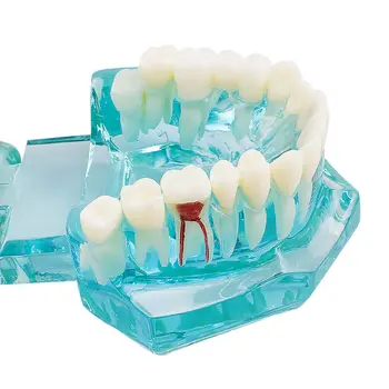 Dentare Studiu Dinte Model Adult Patologice de predare Dinți model nou denshine